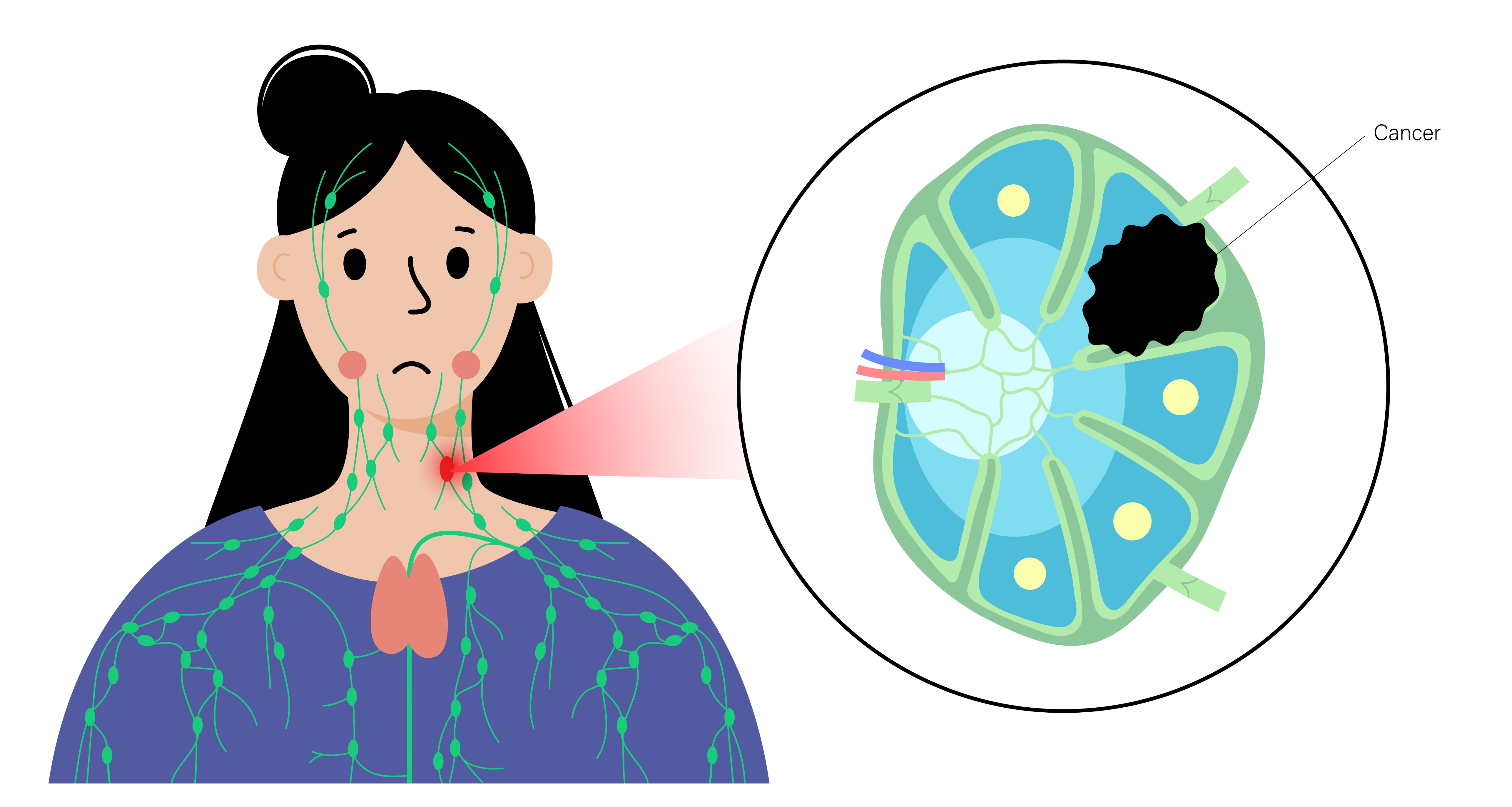 30837741_lymphnode_42 (1).jpg